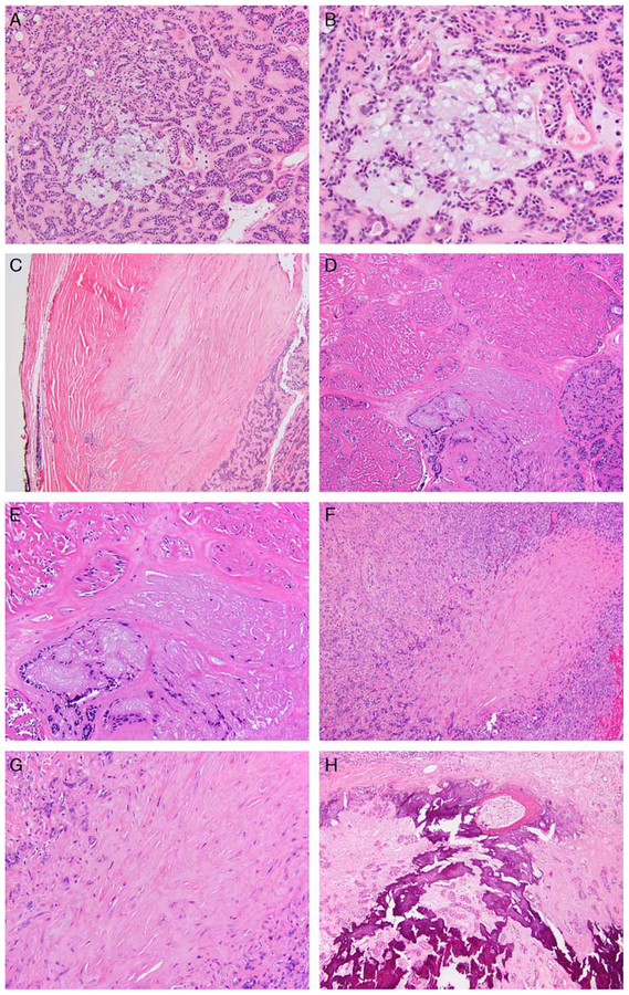 Epithelial-Myoepithelial Carcinoma: Frequent Morphologic and Molecular ...