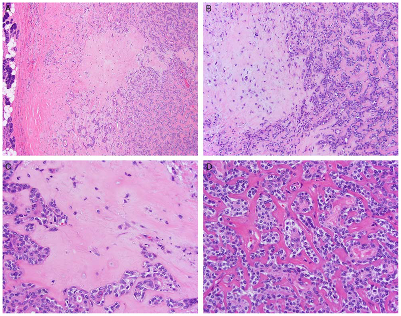 Epithelial-Myoepithelial Carcinoma: Frequent Morphologic and Molecular ...