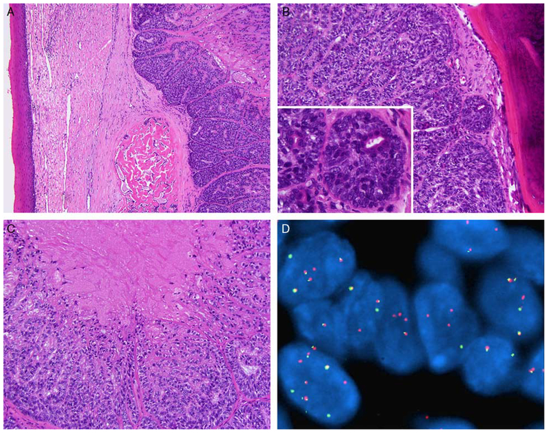 Epithelial-Myoepithelial Carcinoma: Frequent Morphologic and Molecular ...