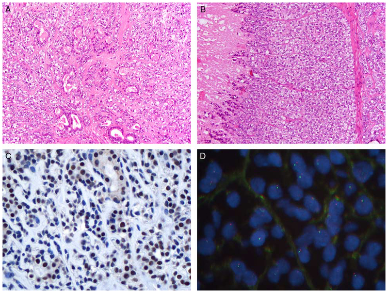 Epithelial-Myoepithelial Carcinoma: Frequent Morphologic and Molecular ...