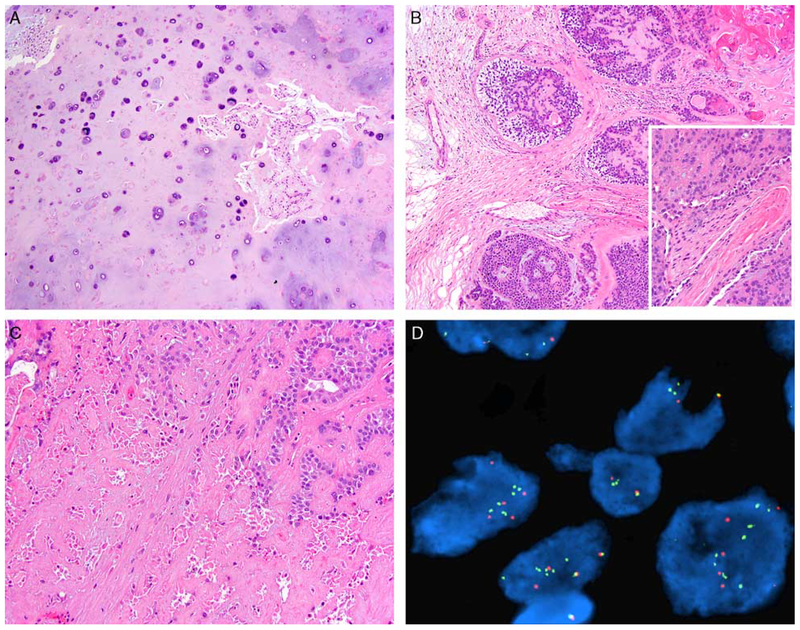 Epithelial-Myoepithelial Carcinoma: Frequent Morphologic and Molecular ...