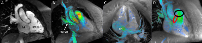 Cardiac-gated MR angiography and four-dimensional (4D) flow images from patient 2 with partial anomalous pulmonary venous return (PAPVR) of the right upper lobe. Right ventricular outflow tract views from, A, MR angiography and, B, 4D flow show the connection between the right upper lobe pulmonary vein and superior vena cava. In C, four-chamber view shows an enlarged right atrium (RA) and left-to-right flow through a large secundum atrial septal defect. In D, red and black circles highlight the location of blood flow measurements in the ascending aorta and main pulmonary artery, respectively. LV = left ventricle, RV = right ventricle.