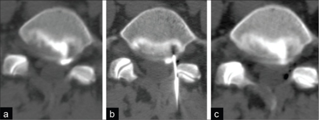 Successful treatment of a symptomatic L5/S1 discal cyst by percutaneous ...