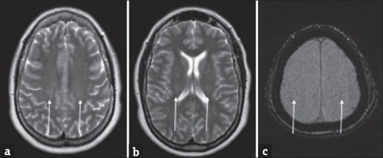 Amyotrophic Lateral Sclerosis and its Mimics/Variants: A Comprehensive ...