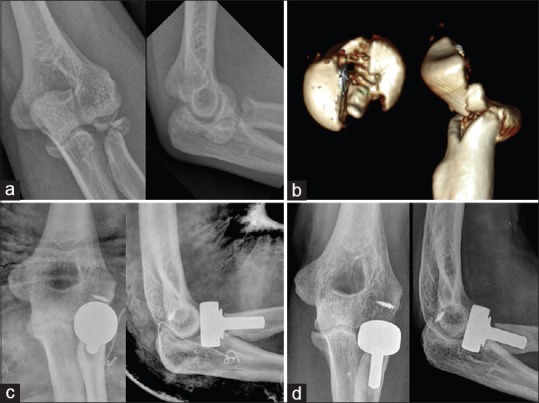 Treatment Of Modified Mason Type Iii Or Iv Radial Head Fracture Open Reduction And Internal