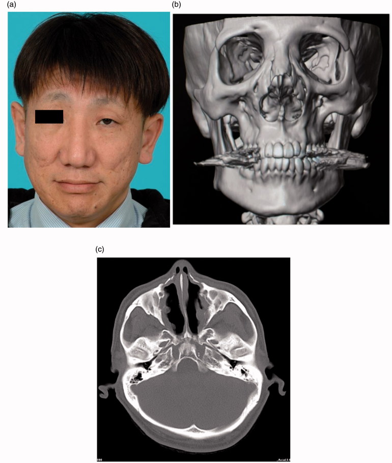 Rhinoplasty of a severe broad nose deformity caused by radical surgery