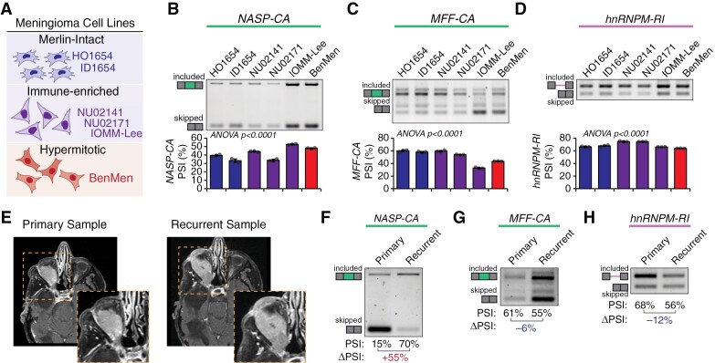 RNA splicing events detected in hypermitotic meningiomas are validated in cell lines and an independent patient sample using RT-PCR.