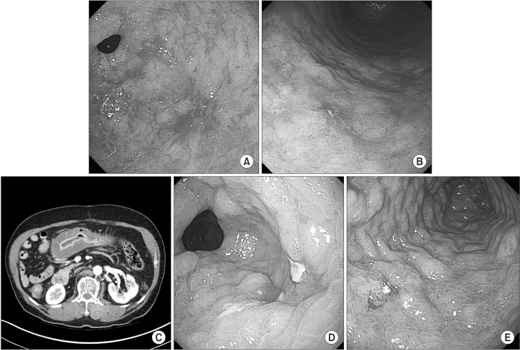 Phlegmonous Gastritis with Early Gastric Cancer - PMC