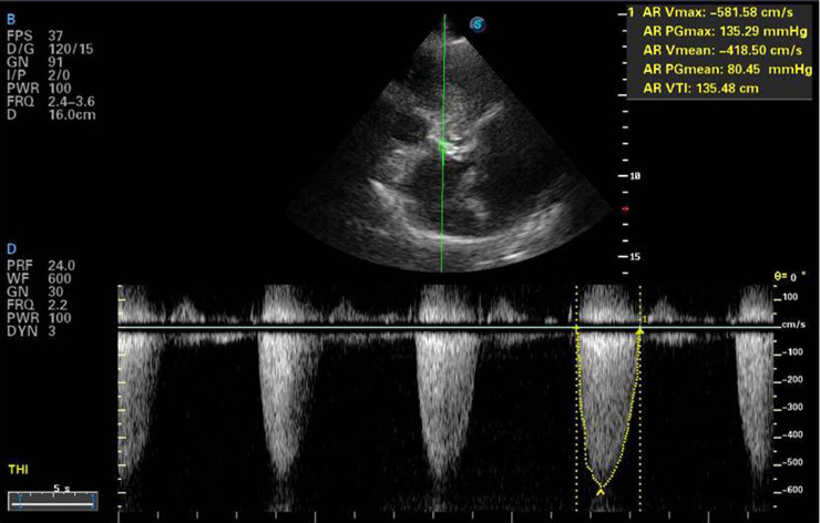 Coronary To Pulmonary Artery Fistula Associated With Significant Coronary Atherosclerosis And