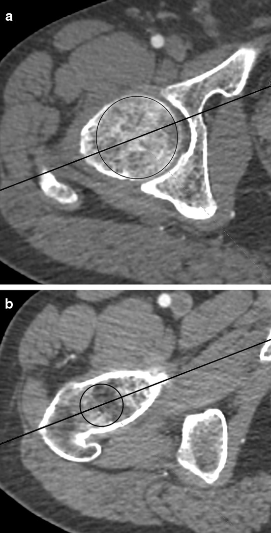 The position and morphometry of the fovea capitis femoris in computed ...