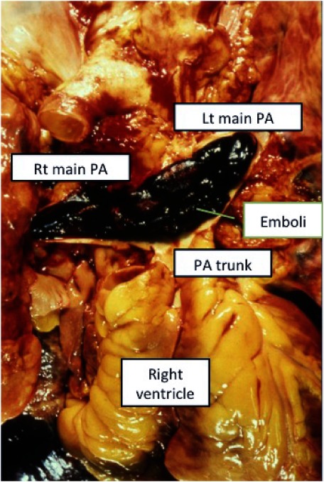 Fig. 1 Autopsy photo of the pulmonary trunk in a patient with massive pulmonary embolism. Sausage-like thrombi pack the pulmonary trunk and bilateral main pulmonary arteries.