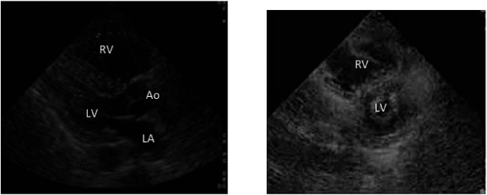 Fig. 2 Right ventricular load in massive pulmonary embolism seen on a trans-thoracic echocardiogram. Left, long-axis view of the heart in a patient with massive pulmonary embolism. Right, short-axis view of the heart in the same patient. Note the enlarged right ventricle and small left ventricle. RV: right ventricle; LV: left ventricle; Ao: ascending aorta; LA: left atrium