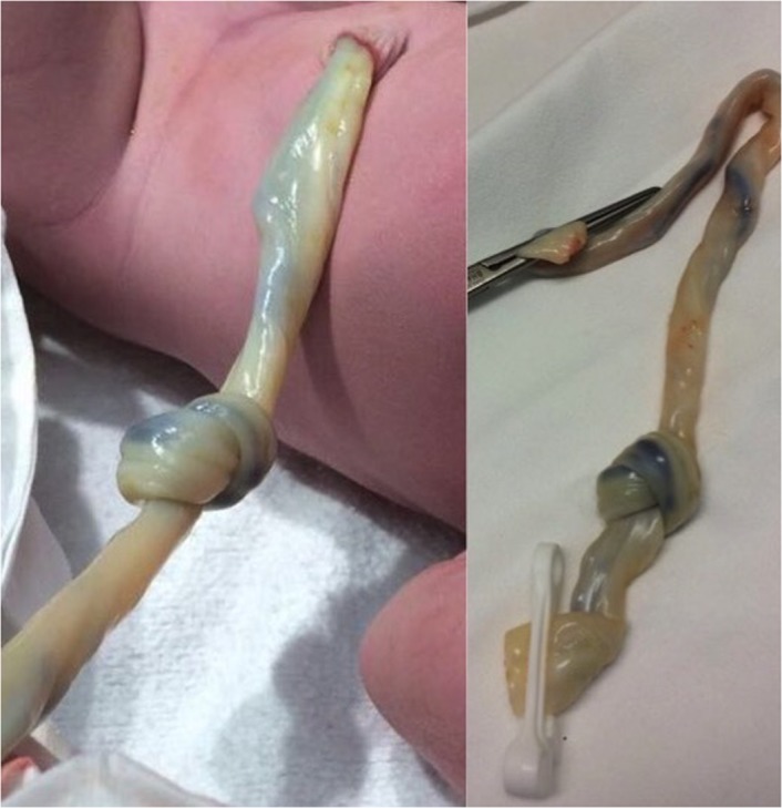 True umbilical cord knot an emergency during labor pmc