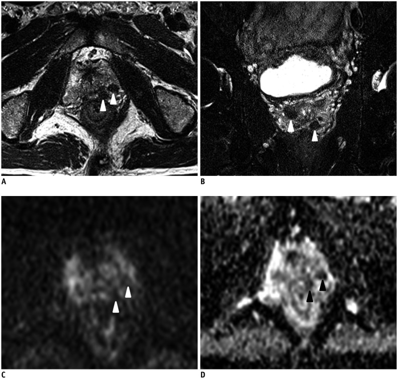 Multiparametric Magnetic Resonance Imaging Characteristics Of Prostate 