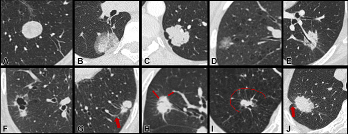 Representative targeted CT images and corresponding semantic descriptors of lung nodules. A–F demonstrate different nodule consistencies and margin characteristics: (A) solid consistency, smooth margin; (B) part-solid consistency, smooth margin; (C) solid consistency, lobulated margin; (D) ground-glass consistency, lobulated margin; (E) solid consistency, spiculated margin; and (F) pericystic solid nodule, spiculated margin. G–J demonstrate different external characteristics of the surrounding perinodule lung parenchyma: (G) vascular convergence (arrow), (H) perinodule septal stretching (lines), (I) perinodule septal stretching with halo of paraseptal emphysema (line demarcates the emphysematous halo), and (J) pleural retraction (arrow).