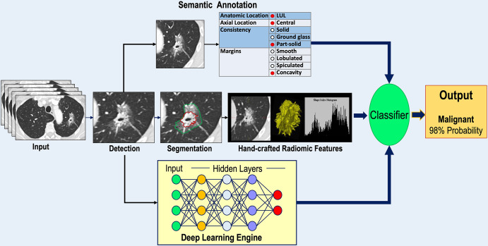 Diagram shows an overview of the major approaches to indeterminate pulmonary nodule classification and characterization of early lung cancer. A lung nodule detected on a CT scan may be annotated using semantic terms, undergo segmentation for extraction of radiomic features, or serve as input to a deep learning engine. The outputs of each analysis pathway are then submitted to some form of classifier to produce an output providing a probability of lung cancer or prediction of the histologic characteristics and/or genetic makeup of a known lung cancer. LUL = left upper lobe.