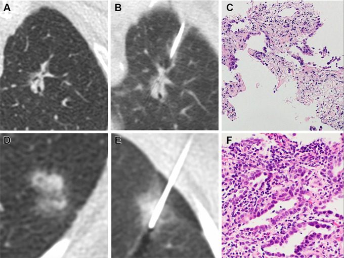 (A–C) Images in a 70-year-old woman without emphysema who is a current smoker. (A) Image from lung screening CT examination shows a part-solid nodule with a 26-mm mean diameter and a 9-mm solid component in the left upper lobe. The model developed by McWilliams et al (19) yielded a 78.1% probability of cancer given patient’s age, sex, and negative family history of lung cancer, and the nodule consistency, size, and location. (B) Image shows CT-guided percutaneous lung biopsy procedure. (C) Photomicrograph (hematoxylin-eosin stain) shows atypical epithelial cells with chronic inflammation and scarring. The patient underwent left upper lobectomy with resection of an invasive adenocarcinoma with a primarily acinar pattern, with papillary and lepidic components. (D–F) Images in a 68-year-old woman without significant emphysema who is a former smoker. (D) Image from low-dose CT examination of the chest shows part-solid nodule in the left lower lobe with a 14.1-mm mean diameter and a 13-mm solid component. The model developed by McWilliams et al (19) gave a 20.1% probability of malignancy. (E) Image shows CT-guided percutaneous lung biopsy procedure. (F) Photomicrograph (hematoxylin-eosin stain) shows well to moderately differentiated invasive lung adenocarcinoma with lepidic and focal acinar patterns.