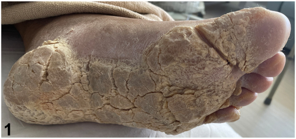 Painful Thickened Skin On The Soles Of The Feet - Pmc