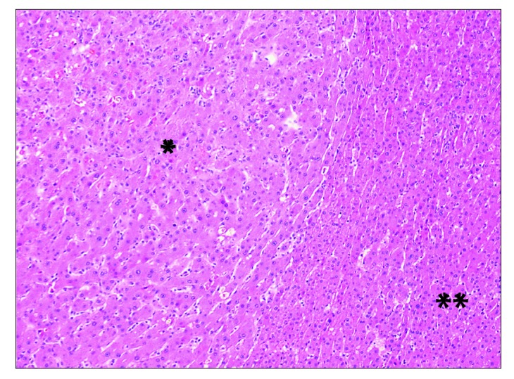 Beta-Catenin Staining of Hepatocellular Adenomas - PMC