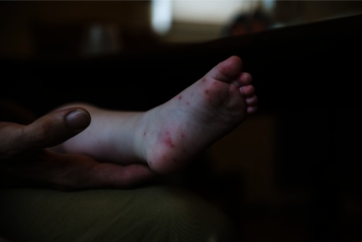 Photograph of the blistered foot of a child with hand, foot, and mouth disease