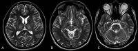 Figure depicting classical MRI findings in Wilson’s disease