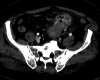 Axial and coronal image showing inflammatory mass adjacent to sigmoid.