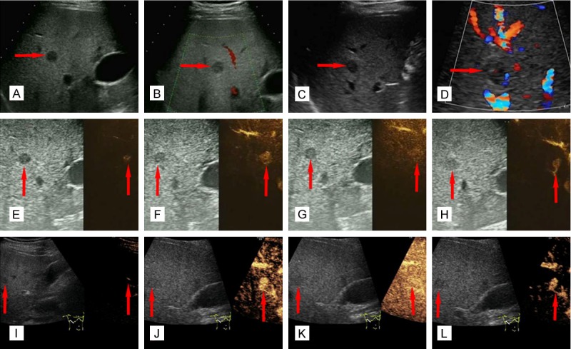 Imaging findings of bile duct hamartomas: a case report and literature ...