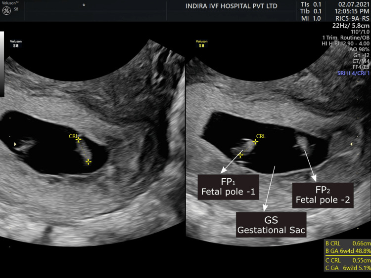 Successful Management Of Triplet Heterotopic Pregnancy Interstitial