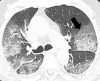 Images in patient with coronavirus disease 2019 (COVID-19) pneumonia. (a, b) Typical CT aspect of COVID-19 pneumonia: initial phase of disease with areas of ground-glass opacity peripherally (arrow in a); severe phase of disease with diffuse crazy paving pattern (arrow in b). Pleural effusions are absent.