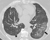 Images in 74-year-old woman with HKU1 coronavirus pneumonia. (a) CT scan performed at admission shows a large area of peripheral ground-glass opacity (arrow) in the lower left lobe and small pleural effusions (star). (b) The CT scan performed after 14 days shows almost complete resolution of the imaging findings.