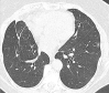 Images in 74-year-old woman with HKU1 coronavirus pneumonia. (a) CT scan performed at admission shows a large area of peripheral ground-glass opacity (arrow) in the lower left lobe and small pleural effusions (star). (b) The CT scan performed after 14 days shows almost complete resolution of the imaging findings.