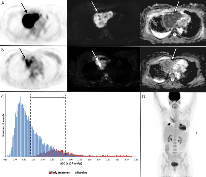 Example of a 41-year-old woman with stage I primary mediastinal B-cell lymphoma. A, Mediastinal mass (arrow) with high fluorine 18 (18F) fluorodeoxyglucose (FDG) uptake at 18F-FDG PET/CT (left), high b1000 signal at diffusion-weighted (DW) imaging (middle), and low signal on apparent diffusion coefficient (ADC) map (right). B, After 2 weeks, 18F-FDG uptake of the mass (arrow) was in keeping with good partial response. DW imaging shows decreased signal on the b1000 images and marked increase of ADC (from 1.02 to 1.80 × 10−3 mm2/sec), confirmed on, C, the ADC histogram, indicating good outcome. D, End-of-treatment 18F-FDG PET/CT shows inflammatory changes (arrowhead), yet complete remission, which was maintained until the end of follow-up.