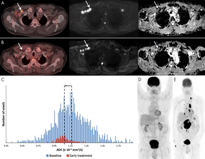 Example of a 59-year-old male patient with stage IV diffuse large B-cell lymphoma with recurrent disease. A, At baseline, fluorine 18 (18F) fluorodeoxyglucose (FDG) PET/CT (left), b1000 diffusion-weighted (DW) imaging (middle), and corresponding apparent diffusion coefficient (ADC) map (right) demonstrate involvement of right cervical lymph nodes (arrow). B, After 3 weeks of therapy, the 18F-FDG PET/CT scan was negative to disease, but at DW imaging the nodes (arrow) still show high b1000 signal intensity and low ADC. C, Although the ADC-derived histogram shows a marked volume decrease, there is also a decrease in ADCmean (from 1.16 to 1.07 × 10−3 mm2/sec), rendering this a poor outcome. D, End 18F-FDG PET/CT still shows complete remission. E, After 20 months, a follow-up 18F-FDG PET/CT shows recurrent disease in multiple lymph node regions above and below the diaphragm.