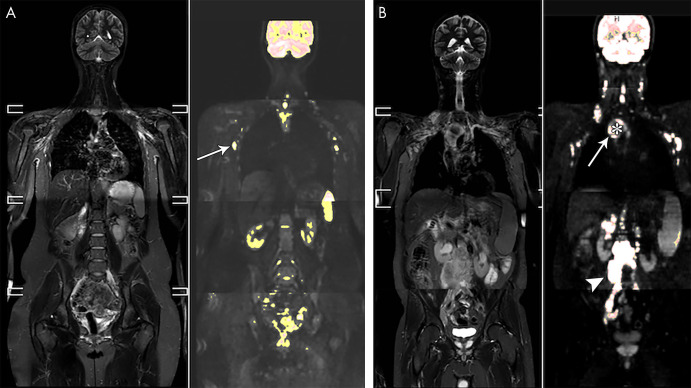 A, Whole-body short-tau inversion-recovery (STIR) image in a 21-year-old female volunteer and overlay of a color-scaled diffusion-weighted image. A region-growing segmentation tool with adaptable threshold allows for the identification of lymph nodes, such as the axillary nodes in this patient (arrow). B, Whole-body STIR image and color-scaled diffusion-weighted image overlay in a 50-year-old man with stage IV mantle cell lymphoma. The large mediastinal mass (arrow) was segmented using a high threshold to include only the most hyperintense component of the mass, excluding the central necrotic portion of the tumor (*). Also shown is a large solid retroperitoneal mass (arrowhead).