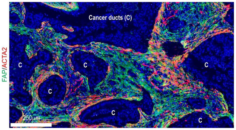 The Desmoplastic Stroma of Pancreatic Cancer: Multilayered Levels of ...