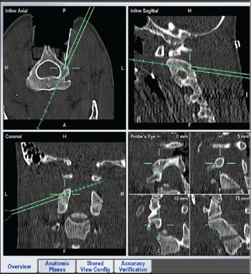 Surgical treatment of adult and pediatric C1/C2 subluxation with ...