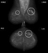 A typical four-view mammogram from a screening episode. The final
screening episode outcome for this woman was true positive, with a
screen-detected cancer on the left breast as annotated. The left breast
images were classified with this final screening episode outcome along with
the associated reading and assessment outcomes. The lesion on the right
breast was also indicated for assessment and determined to be benign. As
such, the right breast images, although associated with a true-positive
screening episode, were classified with the less prognostically significant
reading (recall for assessment) and assessment (assessed normal with benign
lesion) outcome. CC = craniocaudal, L = left, MLO = mediolateral, R =
right.