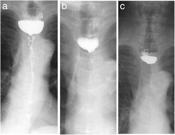 Successful bypass operation for esophageal obstruction after acute ...