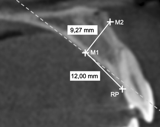 Figure 2. CBCT screenshot of the sagittal plane with the reference point (RP) at the cementoenamel junction (CEJ) of a maxillary central incisor and a measurement of the bone thickness 12.00 mm posterocranial of this RP, perpendicular to the bony surface. The dotted line is the tangent to the palatal contour in measurement point M1.