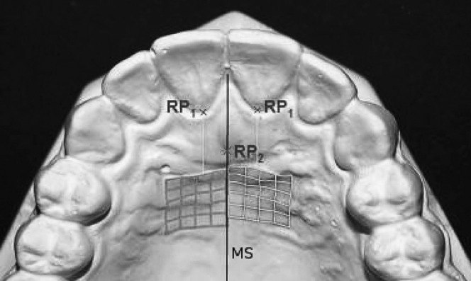 Figure 1. Schematic representation of the palatal reference and measurement points. RP1  =  reference point 1, the most apical points of the CEJ of the left and right maxillary central incisor, respectively. RP2  =  reference point 2, intersection of the median sagittal plane with the posterior bony surface of the incisive foramen. MS  =  median sagittal plane.