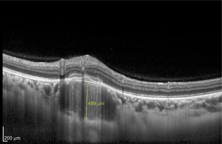 Choroidal tuberculoma as a presenting sign of tuberculosis - PMC