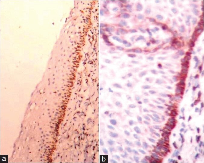 P53 And Bcl2 Expression In Malignant And Premalignant Lesions Of 