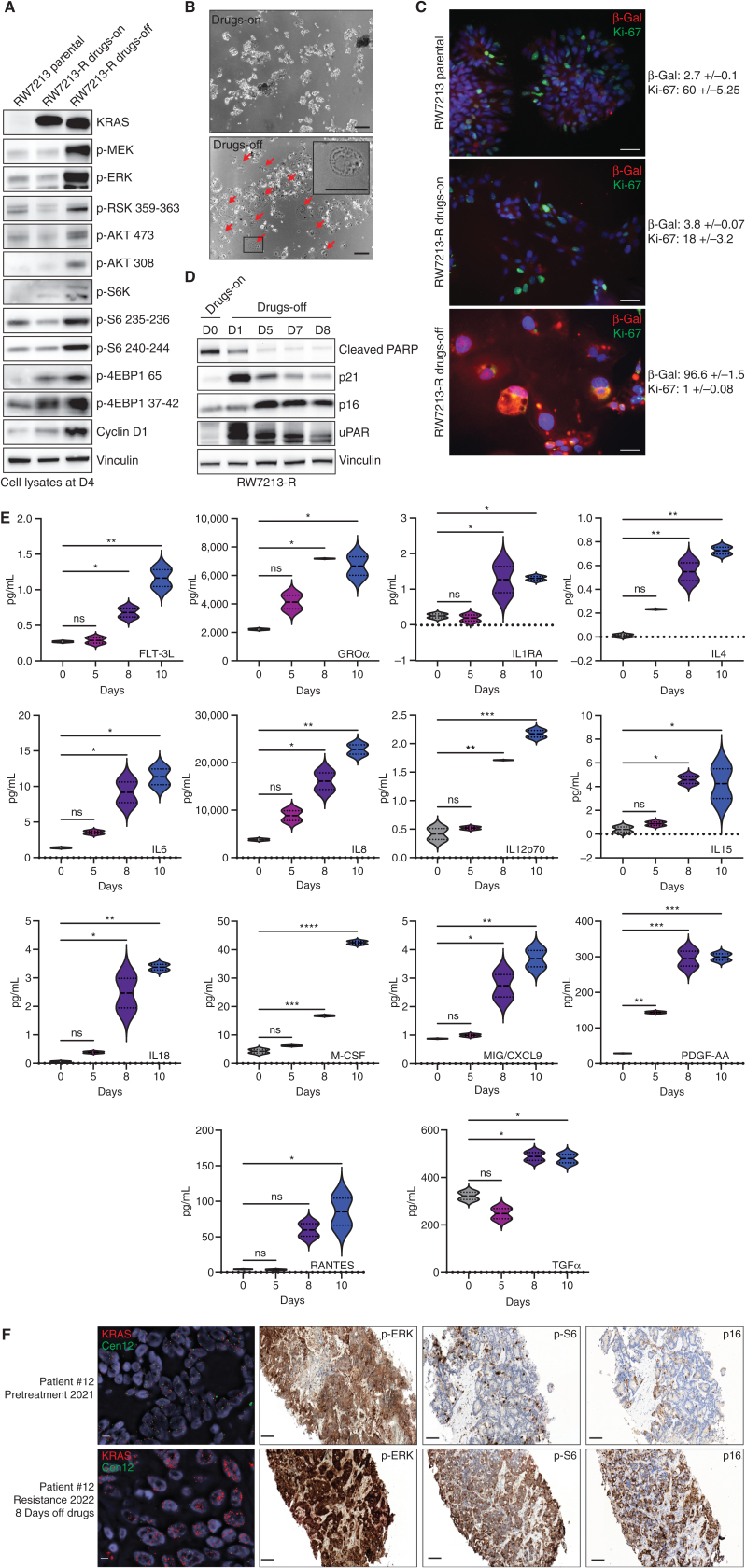 Figure 3. Drug withdrawal drives senescent phenotype in resistant colorectal cancer cell line with acquired KRASG12C amplification. A, Western blot analyses of the effects on MAPK and mTOR pathway regulation in RW7213 parental cells and in RW7213-R with and without cetuximab–sotorasib combination; vinculin is included as a loading control. B, Microscopy images of RW7213-R with and without cetuximab/sotorasib combo: 10× magnification; scale bars, 100 μm. In the right, the black square represents the area magnified in the upper-right corner inset. C, Ki-67 and β-Gal staining by immunofluorescence (time point 4 days). 10× magnification; scale bars, 100 μm. Quantification represents the percentage of β-Gal and Ki-67–positive cells per total number of cells, ± symbol indicates variation between pictures. 10 independent pictures have been quantified per condition. D, Western blot analyses of p16, p21, caspase-3, cleaved PARP and uPAR expression upon drug withdrawal, vinculin is included as a loading control. E, SASP cytokine array time-course experiment. Data shown represent duplicates. Statistical analyses and P values represent two-way ANOVA with Dunnett multiple comparison test. ns (not significant) = P > 0.05; *, P ≤ 0.05; **, P ≤ 0.01; ***, P ≤ 0.001; ****, P ≤ 0.0001. F. FISH staining for KRAS (scale bar, 5 μm) and IHC for phospho-ERK, phospho-S6 (S235), and p16 in tissue samples collected from patient 12, consisting of pretreatment liver metastasis biopsy (pretreatment 2021) and progression liver metastasis biopsy collected 8 days after stopping KRASG12C and EGFR inhibitors (resistance 2022). Mean KRAS (red)/Cen12 (green) ratio, based on manual counting of 50 cells from each time point, was 1.8 for the pretreatment specimen and 13.2 for the resistance specimen. Phospho-ERK staining was 2+ involving >90% of cells pretreatment and 3+ involving >90% of cells at progression; phospho-S6 staining was absent pretreatment and 2+ involving 70% of cells at progression; and p16 staining was 2+ involving 5% of cells pretreatment and 2+ involving 65% of cells at progression. Magnification of all IHC slides is 20×, scale bars, 100 μm.