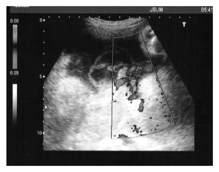 Case Series of Intrauterine Subamniotic Hemorrhage - PMC