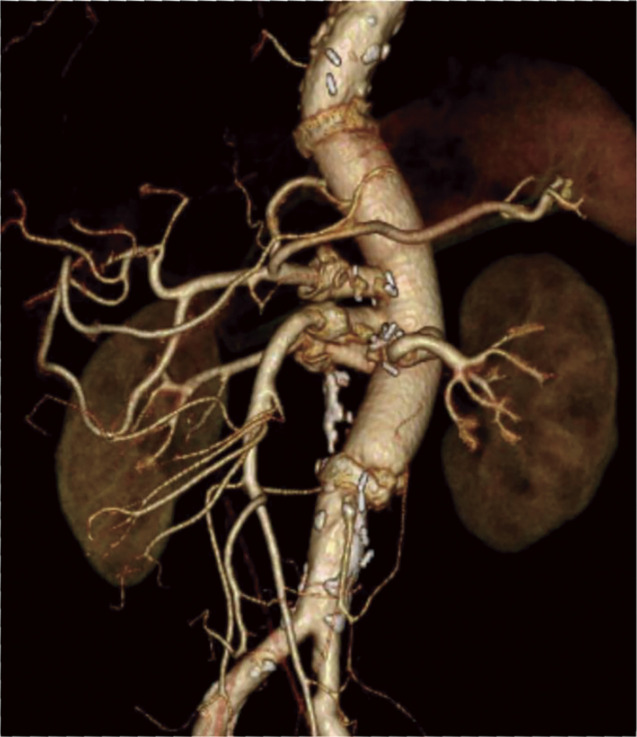 Fig. 2 No abnormalities were observed around the artificial blood vessel and the anastomosis.