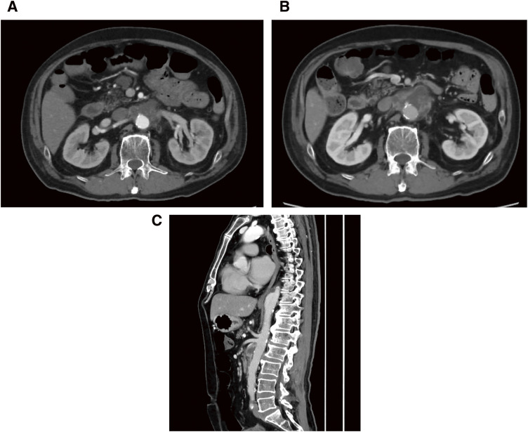 Fig. 1 (A) CT showed an increase in fat concentration around the superior mesenteric artery and an aneurysm-like form (45 × 34 mm) with irregular walls. (B and C) CT showed rapid expansion of the aneurysm with a diameter of 54 × 37 mm. CT: computed tomography