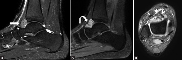 Review of Soft Tissue Masses of the Foot and Ankle: Magnetic Resonance ...