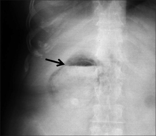 Emphysematous cholecystitis: Imaging findings in nine patients - PMC