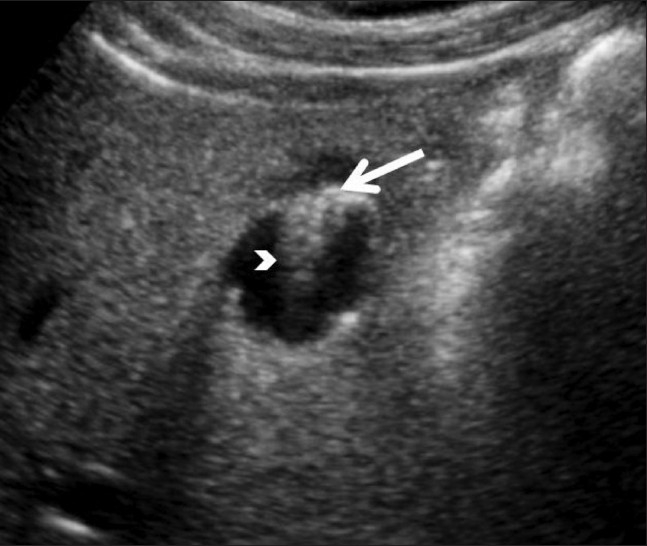 Emphysematous cholecystitis: Imaging findings in nine patients - PMC