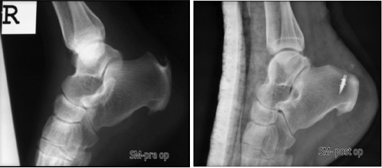 Fig. 1: Radiographs comparing the pre-operative (left image) and post-operative (right image) of a subject, SM, a 48 year-old woman.